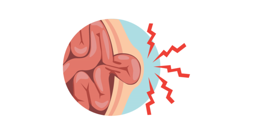 ¿Sospechas que tienes una hernia en el ombligo?